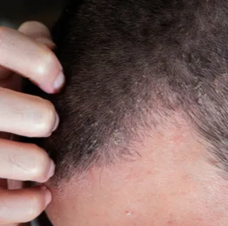 Seborrheic Dermatitis: Itchy Flakes Explained | My Skin