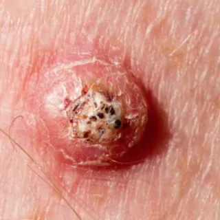 Beyond Sunburns: The Facts About Squamous Cell Carcinoma| Leah Michel, APRN, FNP-BC