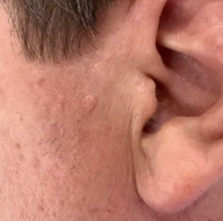 Face the Facts: The Truth About Sebaceous Hyperplasia | Leah Michel, APRN, FNP-BC