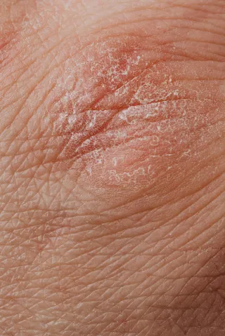Skin Deep: Understanding Common Skin Conditions and Diseases (Part 2) | Leah Michel APRN, FNP-BC