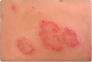 Nummular Dermatitis: Effective Strategies for Relief and Skin Health