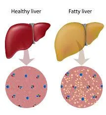 The Basics of Fatty LIver