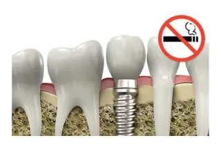 Dental Implants and Smoking: Risks, Complications & Prevention | Blog Metro Dental & Implant Studio