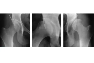 What is Hip Dysplasia?