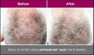 How A Touch of Claridy Revives Confidence Through Hair Replacement?