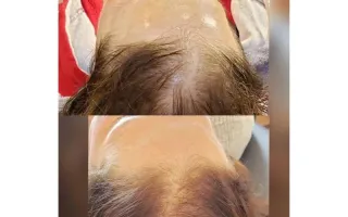 Revitalize Your Locks with Thin Hair Treatment in Indianapolis