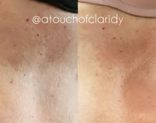 Unlock Radiant Skin with A Touch of Claridy in Indianapolis
