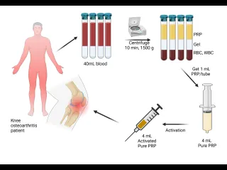 Platelet-Rich Plasma (PRP) Therapy: Regenerative Medicine Using Your Body’s Own Healing Power