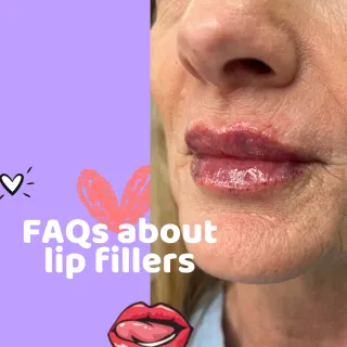 Frequently asked questions about lip fillers