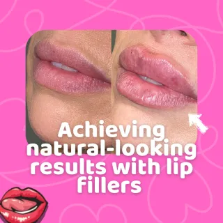 Achieving natural-looking results with lip fillers at Becky Does Botox