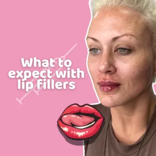 What To Expect With Lip Fillers