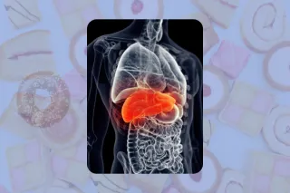 The Hidden Link: How Fructose and Sugar Contribute to Fatty Liver Disease