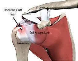 Rotator Cuff Tears — What You Actually Need to Know