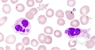 Lyme Coinfection Series-Anaplasmosis