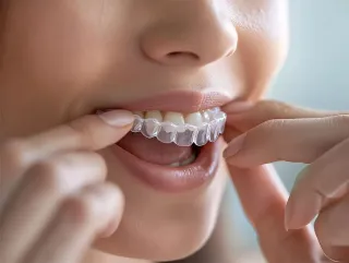 Invisalign in Citrus Park: Clear Aligners at SolSmile Lounge