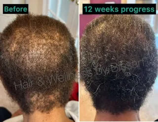 Case: Multiple Types of Alopecia