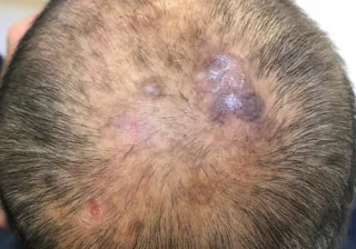Cicatricial Alopecia