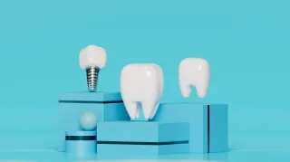 Implantes Dentales: Factores a Considerar antes de Optar por esta Solución