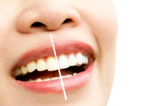 Blanqueamiento Dental: Todo lo que Debes Saber para Lucir una Sonrisa Radiante