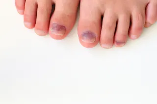 When Should I Worry About a Bruised Toenail?