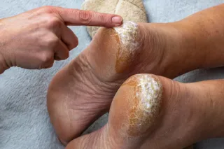 Hard Skin and Cracks on Your Heels? Here’s How We Help