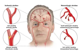 Recognizing a Stroke: A Matter of Life and Time