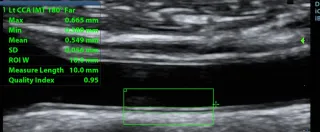 The Clinical Significance of Carotid Intima-Media Thickness in Cardiovascular Health