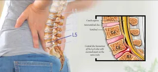 How Chiropractic Care Can Help Neck, Back, and Nerve System Problems Caused by Disc, Arthritis, or Stenosis