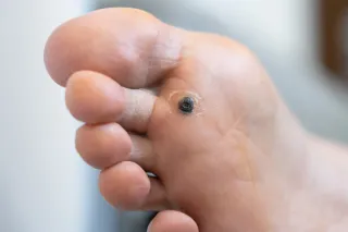 Keeping Your Feet Happy & Healthy: A Guide to Early Plantar Wart Treatment