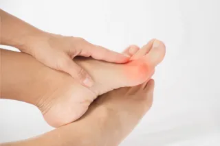 The Role of Arthritis in Bunion Formation: How Joint Health Affects Your Feet