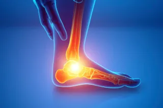 Charcot Foot: A Complication of Diabetes That Needs Fast Action