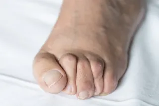 When Your Toes Start Curling: Understanding Hammertoes and Claw Toes

