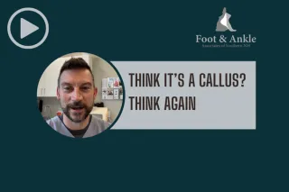 That’s No Callus! How to Catch Plantar Warts Before They Worsen