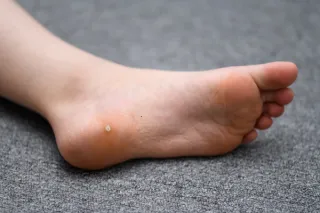 Swift vs. Traditional Wart Treatments: What’s the Difference?