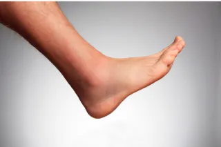 Midfoot Injuries: How to Spot and Treat This Overlooked Problem