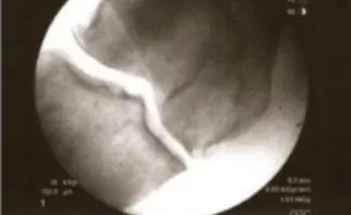 Case Study: Bone-on-Bone Osteoarthritis 