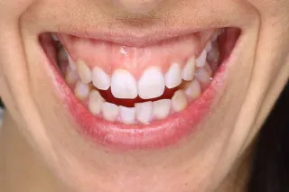 Gummy Smile Solutions: How Gum Contouring Can Reshape Your Confidence