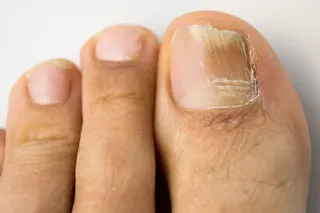 Why Is My Toenail Discolored?