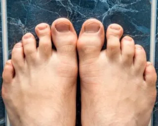 Managing Crooked Toes