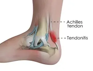 Achilles Tendonitis: Soothing the Overworked Tendon