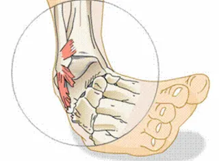 Ankle Sprains: From RICE to Recovery
