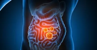 HOW LEAKY GUT CAN CONTRIBUTE TO COMMON PROBLEMS ANF WHAT TO DO

