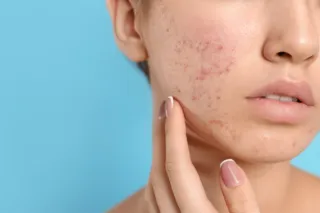 When Skincare Isn’t Enough: Healing Acne From the Inside Out