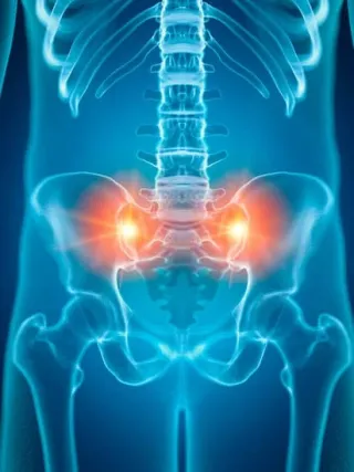 Understanding Sacroiliac Joint Dysfunction: Causes, Symptoms, and Treatment