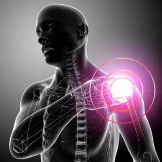 Overcoming Shoulder Impingement: Six Exercises For Fast Relief
