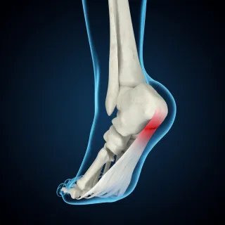 The Fast Track to Healing Plantar Fasciitis: Symptoms, Causes and Rapid Relief Solutions