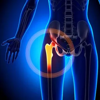 Conquering Hip Pain Part 2: Getting Relief