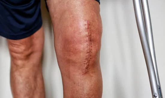7 Costly Mistakes to Avoid After Knee Replacement Surgery