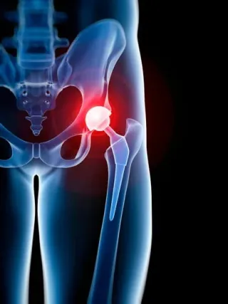 7 Dangerous Mistakes After Hip Replacement Surgery
