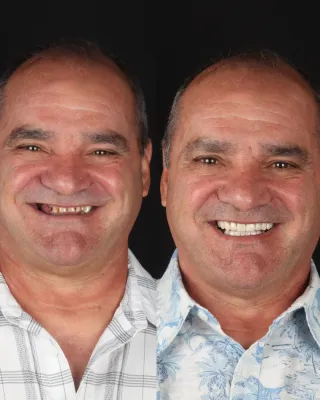 Top 5 Benefits of Dental Implants You Should Know